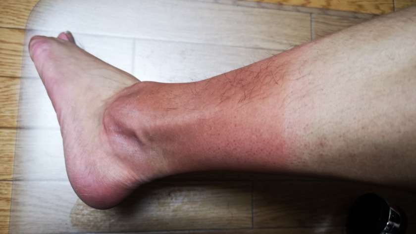 光線アレルギーによって火傷している脚。